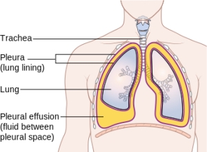 Diagram_showing_a_build_up_of_fluid_in_the_lining_of_the_lungs_(pleural_effusion)_CRUK_054